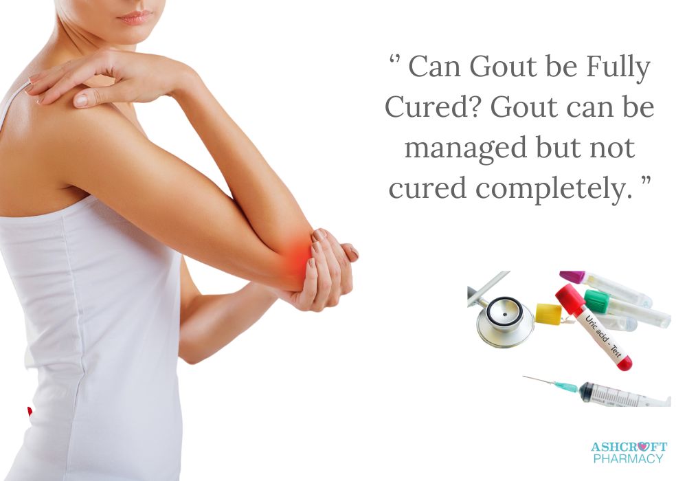 ‘’ Can Gout be Fully Cured Gout can be managed but not cured completely. ’’